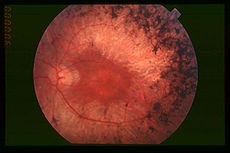 Fundus of patient with retinitis pigmentosa, mid stage Fundus of patient with retinitis pigmentosa, mid stage