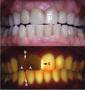 Top, white light view of the teeth and oral structures during a dental examination. No unusual features can be seen. Bottom, the same field viewed under UVA 405nm fluorescence excitation with an orange filter. 