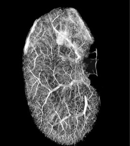 Kidney scan Kidney scan