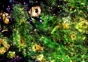 Label-free intraoperative nonlinear imaging of the tumor microenvironment provides real-time visualization of structural and molecular features, including extracellular vesicles that can be potential biomarkers of cancer aggressiveness Credit Biophotonics Label-free intraoperative nonlinear imaging of the tumor microenvironment provides real-time visualization of structural and molecular features, including extracellular vesicles that can be potential biomarkers of cancer aggressiveness Credit Biophotonics