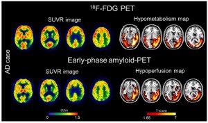 The comparability of early-phase amyloid-PET and FDG-PET images at the single-subject level CREDIT Image created by C Boccalini, et al, University of Geneva, Geneva, Switzerland