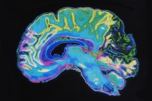 MRI of brain MRI of brain