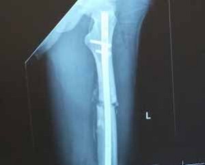 orthopedic implant orthopedic implant