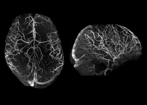 7T angiography in late life depression patients with the Tic-Tac-Toe RF coil system and without the use of invasive contrast agents While not feasible at 3T, 7T super high-resolution acquisitions voxel size is 02 mm in all directions significantly improve 7T angiography in late life depression patients with the Tic-Tac-Toe RF coil system and without the use of invasive contrast agents While not feasible at 3T, 7T super high-resolution acquisitions voxel size is 02 mm in all directions significantly improve