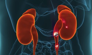 kidney stones can be treated with laser lithotripsy