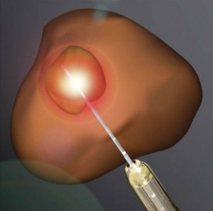 MRI-Guided Focal Laser Ablation Viable prostate cancer treatment MRI-Guided Focal Laser Ablation Viable prostate cancer treatment