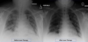 Radiographic Assessment of Lung Edema RALE by CXR showed reduced ground-glass opacities and consolidation following PBMT Lung radiographic score is dependent on extent of involvement based on consolidation or ground-glass opacities for each lung Total sco Radiographic Assessment of Lung Edema RALE by CXR showed reduced ground-glass opacities and consolidation following PBMT Lung radiographic score is dependent on extent of involvement based on consolidation or ground-glass opacities for each lung Total sco
