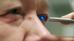 cataract case study